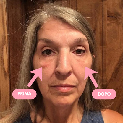 Lifting Temporaneo Contorno Occhi