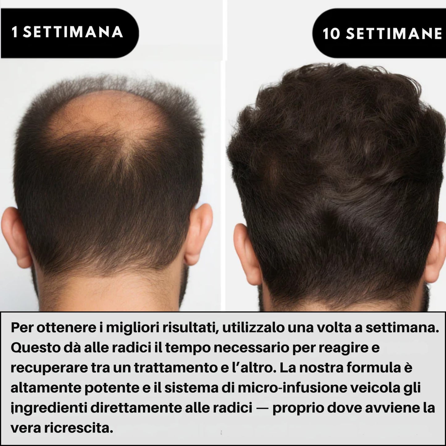 AlphaInfuse | Sistema per la ricrescita dei capelli