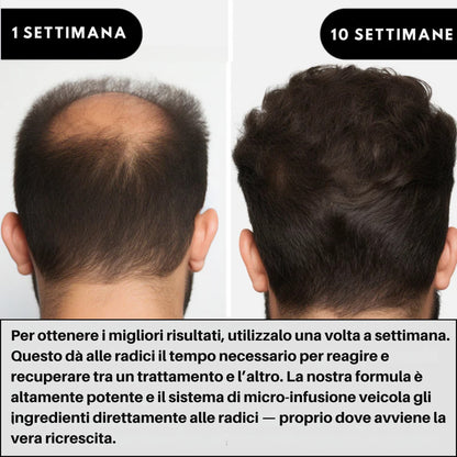 AlphaInfuse | Sistema per la ricrescita dei capelli