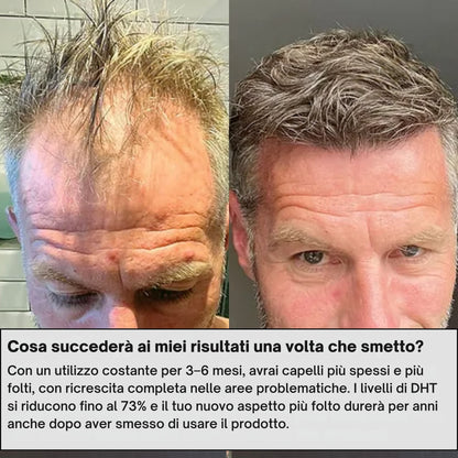 AlphaInfuse | Sistema per la ricrescita dei capelli